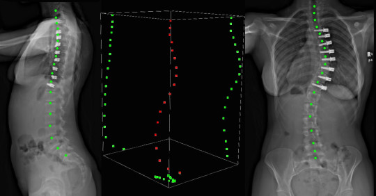 x-ray shows front and side view of scoliosis patient with curvature marked on it in red dots and green dots