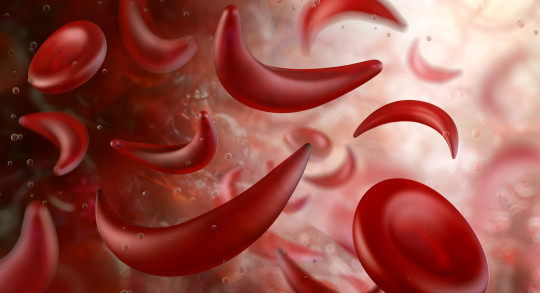 Sickle shaped blood cells.