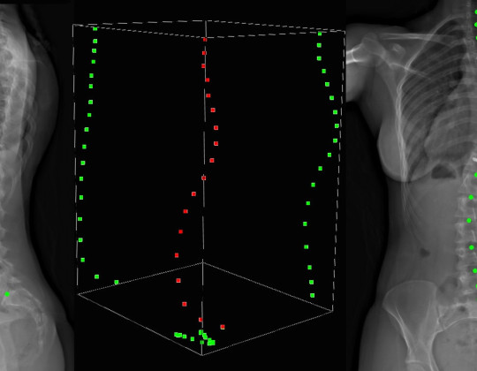 x-ray shows front and side view of scoliosis patient with curvature marked on it in red dots and green dots